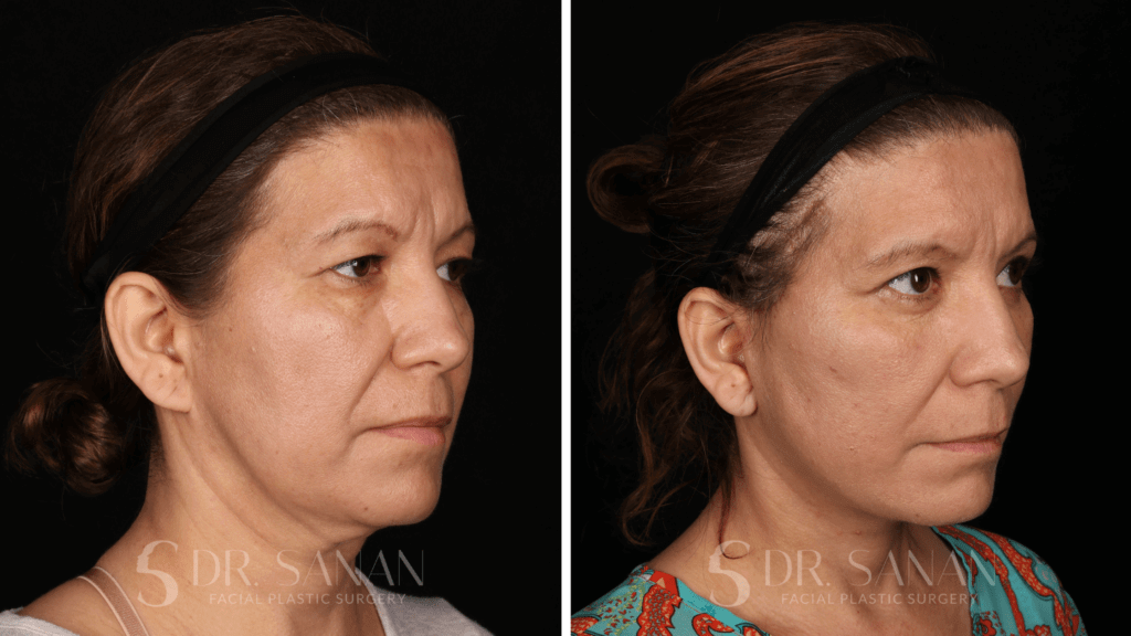 Facelift Boston MA