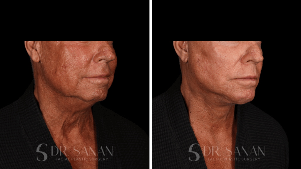 Facelift Procedures Boston MA