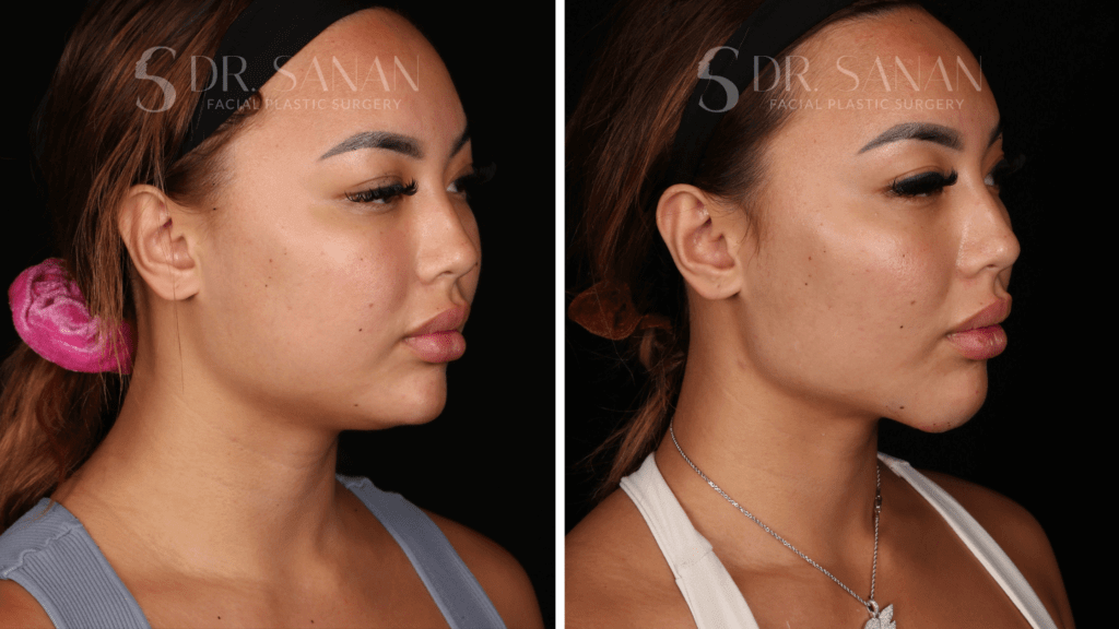 Chin Augmentation Procedure Boston MA