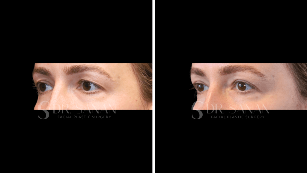 eyelid rejuvenation