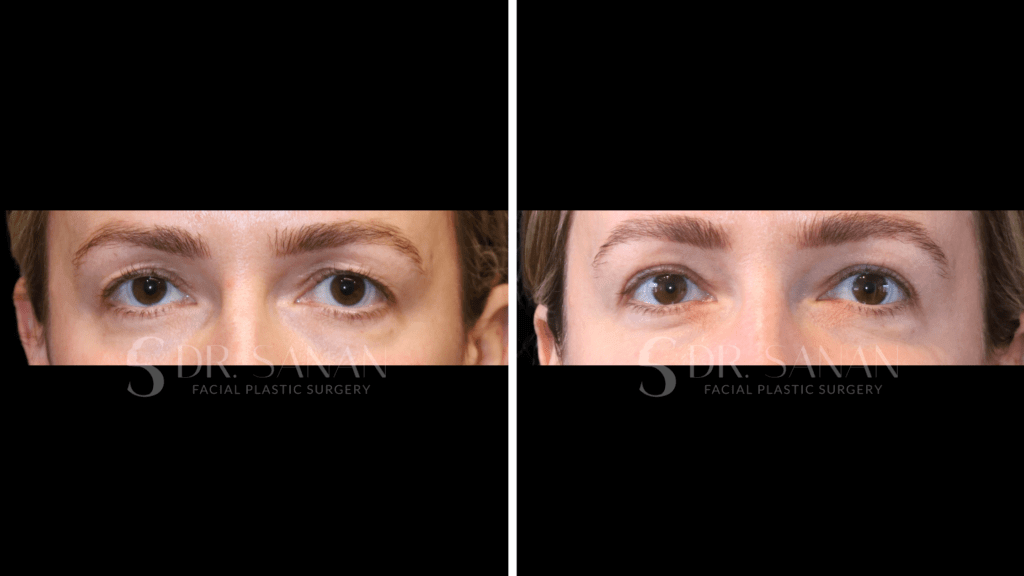 Eyelid Rejuvenation Surgery Boston MA