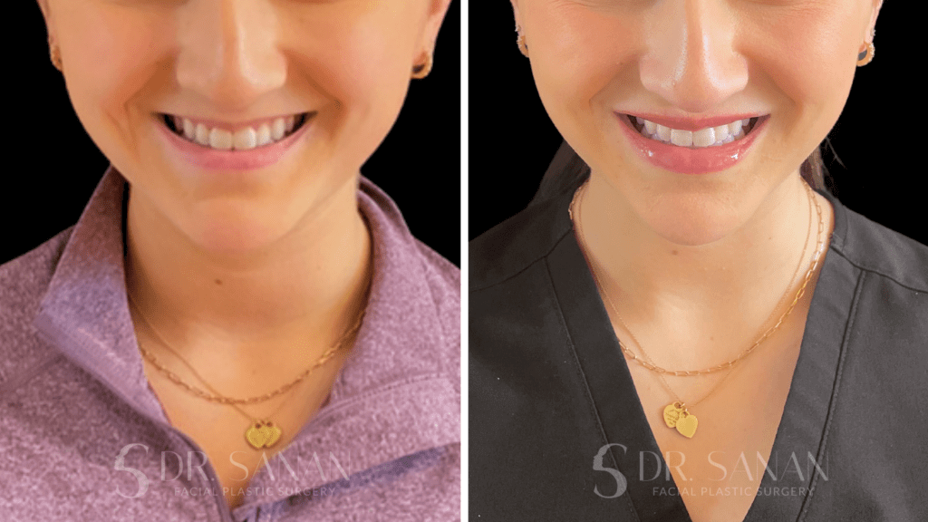 lip filler before & after