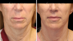 AS-NECKLIFT-01