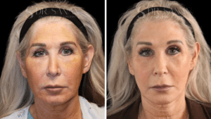 AS-facelift