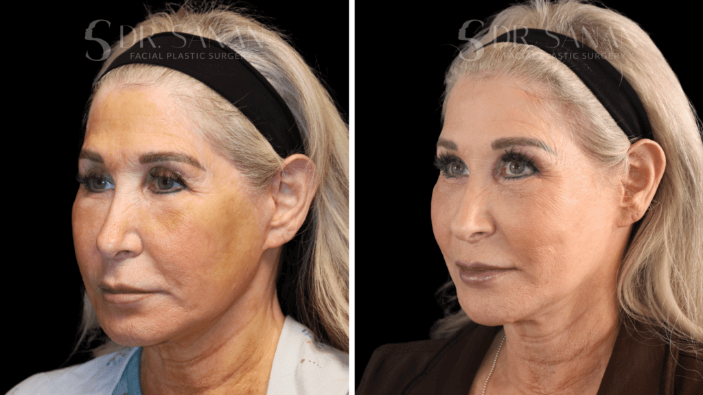 Deep plane facelift