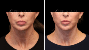 AS-NECKLIFT-05 (7)