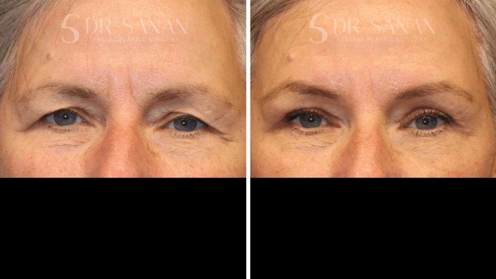 Eyelid Rejuvenation / Upper Blepharoplasty Procedure Boston MA