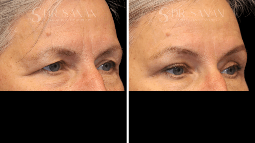 Eyelid Rejuvenation / Upper Blepharoplasty Procedure Boston MA