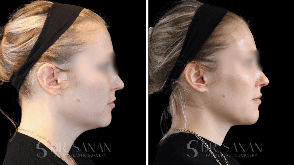 female, 30s, Deep Neck Lift, before & after results