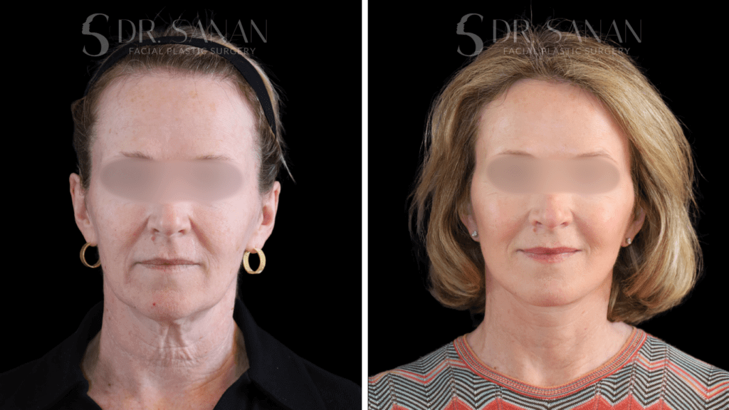 Deep Plane Face & Neck Lift before & after with Dr. Sanan