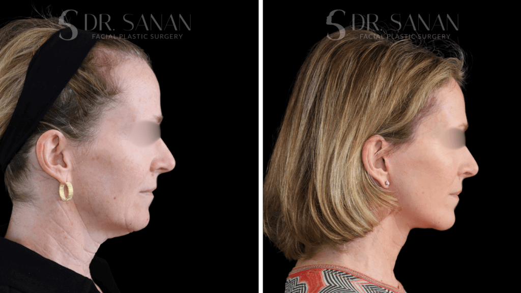 Deep Plane Face & Neck Lift