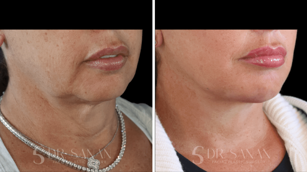 Deep Plane Face & Neck Lift with Chin Augmentation and Fat Grafting. Before & after profile with Dr. Sanan