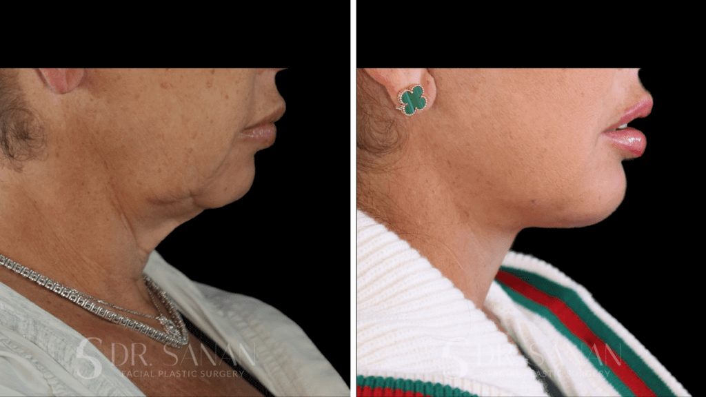 Deep Plane Face & Neck Lift with Chin Augmentation and Fat Grafting. Before & after profile with Dr. Sanan