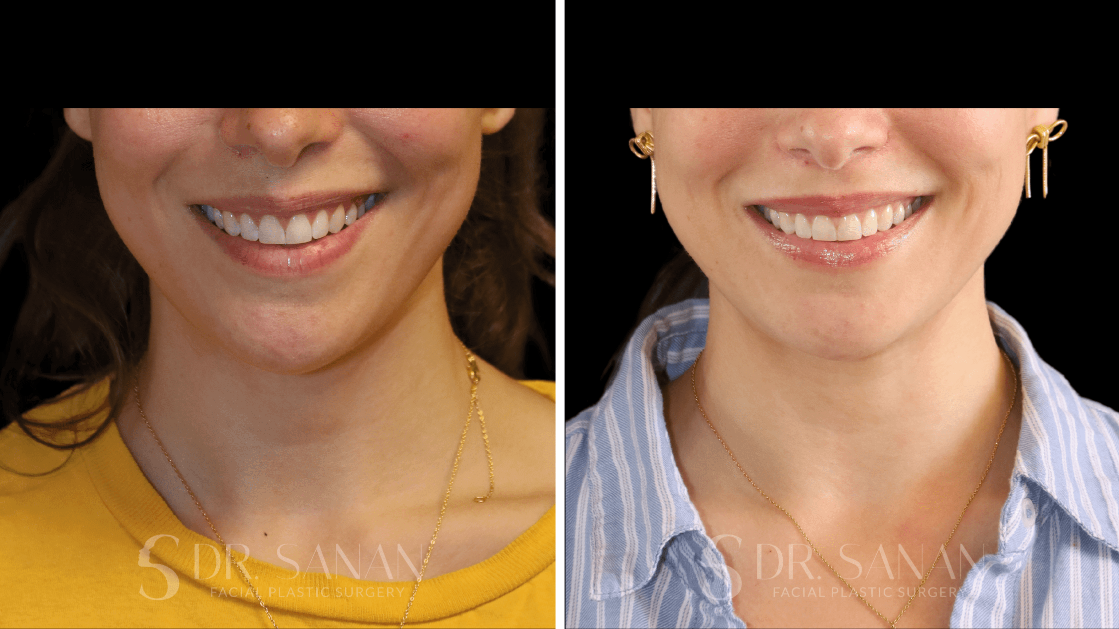 deep plane lip lift by Dr. Sanan in Boston