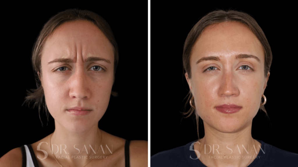 NEUROMODULATOR before & after