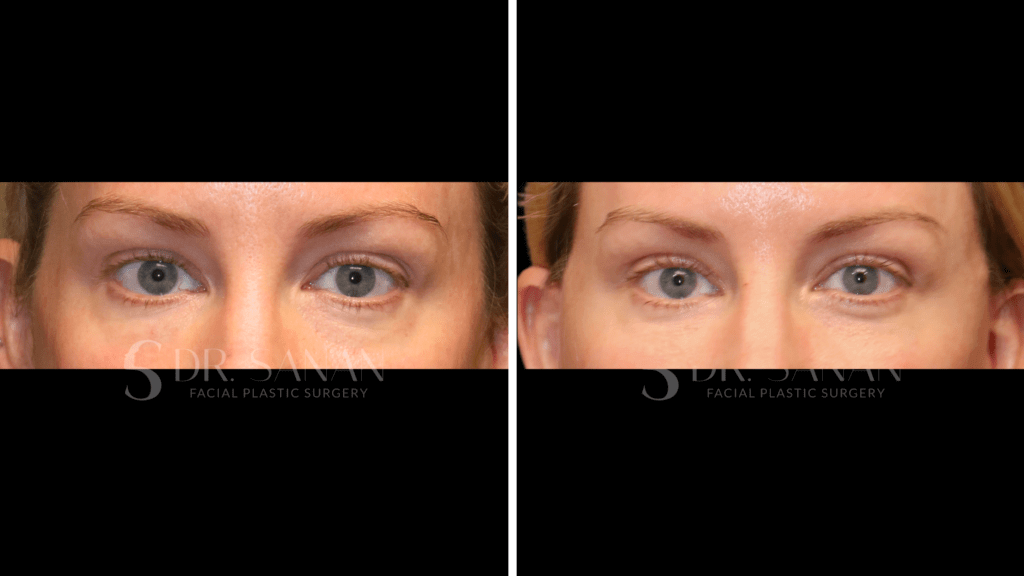 Eyelid Rejuvenation / Upper Blepharoplasty Procedure Boston MA