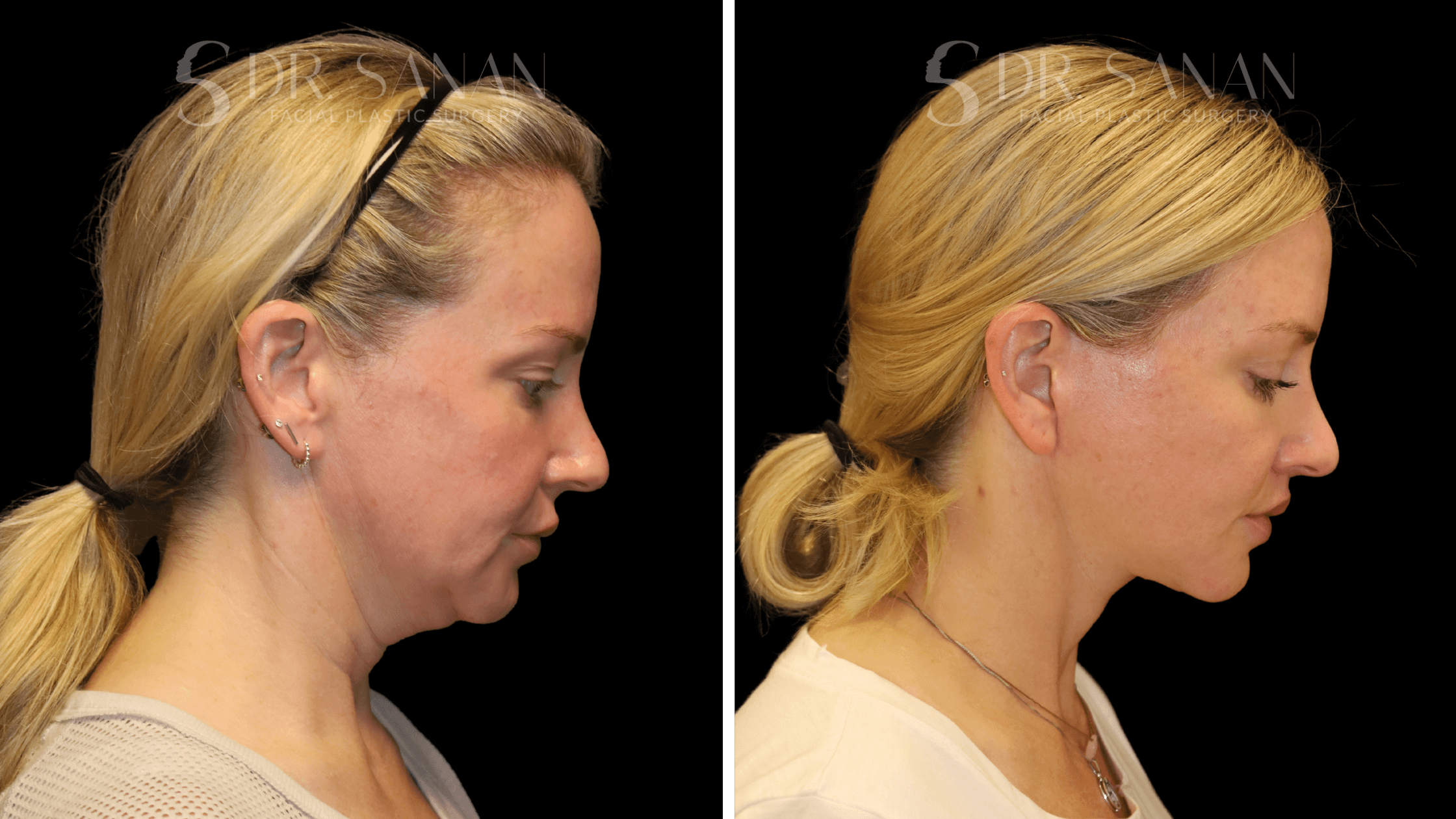 Deep Plane Facelift by Dr. Sanan Boston