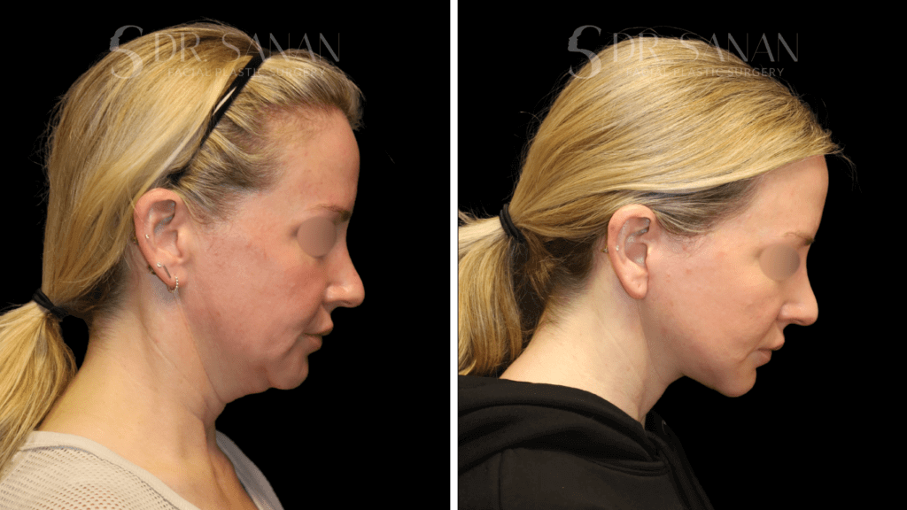 female Deep Plane Face & Neck Lift with Fat Grafting and CO2 Laser