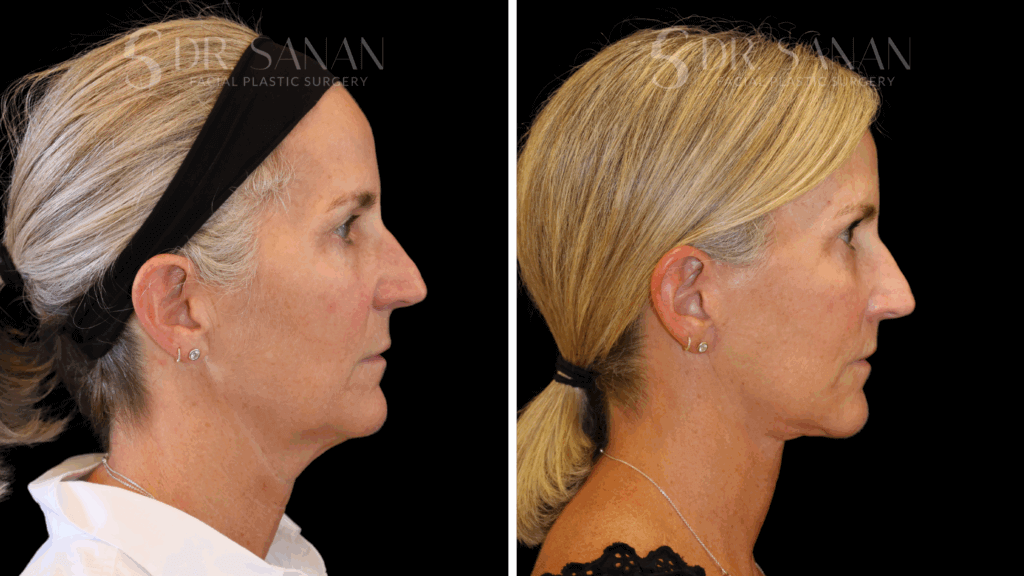 Deep Plane Face & Neck Lift