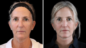 AS-FACELIFT-11