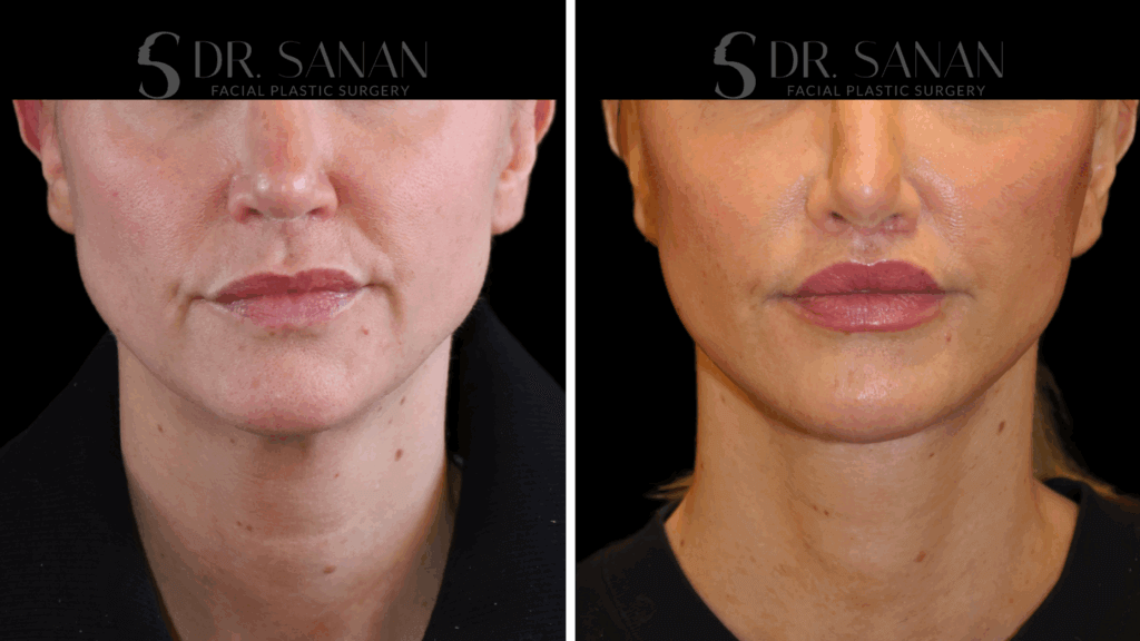 Male Deep Plane Neck Lift by Dr. Sanan in Boston, MA