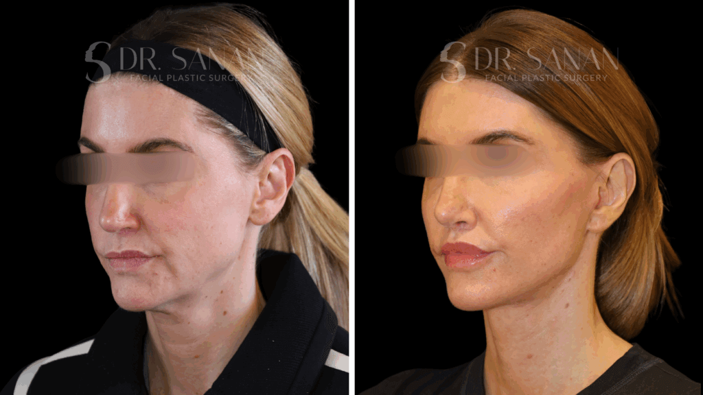 AS-LIPLIFT-01 (5)