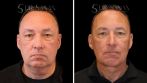 Male Deep Plane Neck Lift by Dr. Sanan in Boston, MA