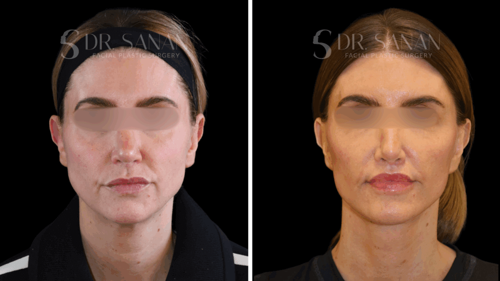 AS-LIPLIFT-01