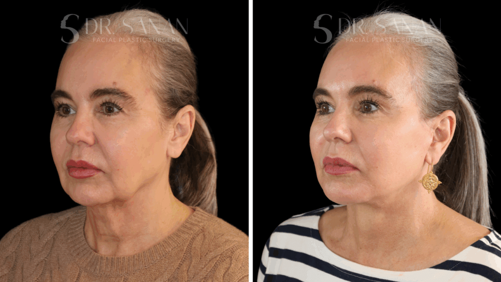AS-LIPLIFT-01 (2)