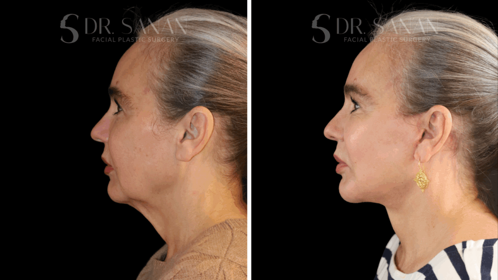 Patient results, she received a Deep Plane Facelift & Neck Lift and Lateral Brow Lift