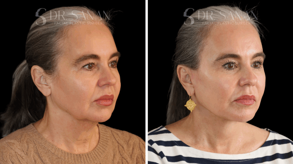 Deep Plane Face & Neck Lift