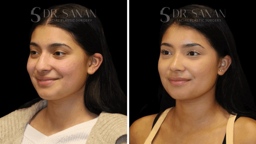 AS-LIPLIFT-01 (6)