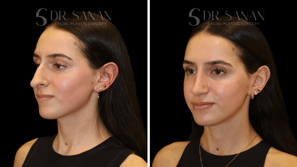 Nose Job Before & After