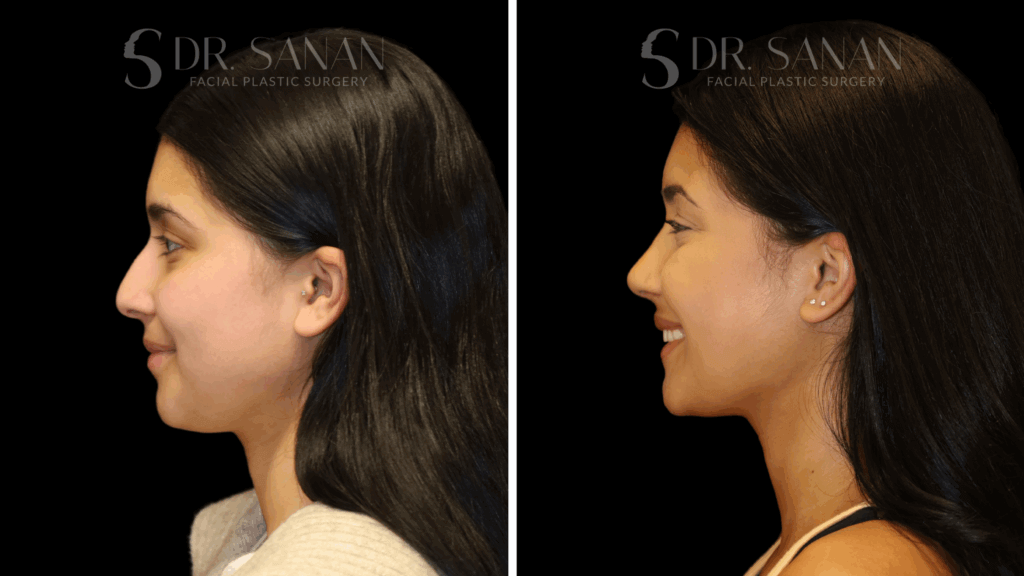 AS-LIPLIFT-01 (7)