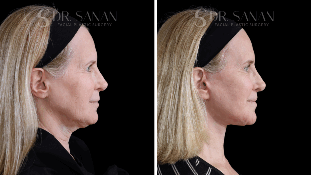 Deep Plane Face & Neck Lift with Endoscopic Brow Lift, Upper Blepharoplasty, Lip Lift, and CO2 Laser