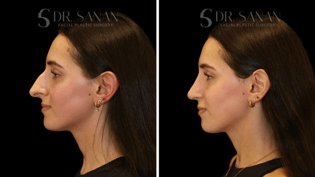 Nose Job Before & After Ultrasonic Piezo Rhinoplasty