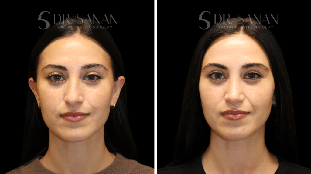 Ultrasonic piezo rhinoplasty in Boston before and after, front view, photo