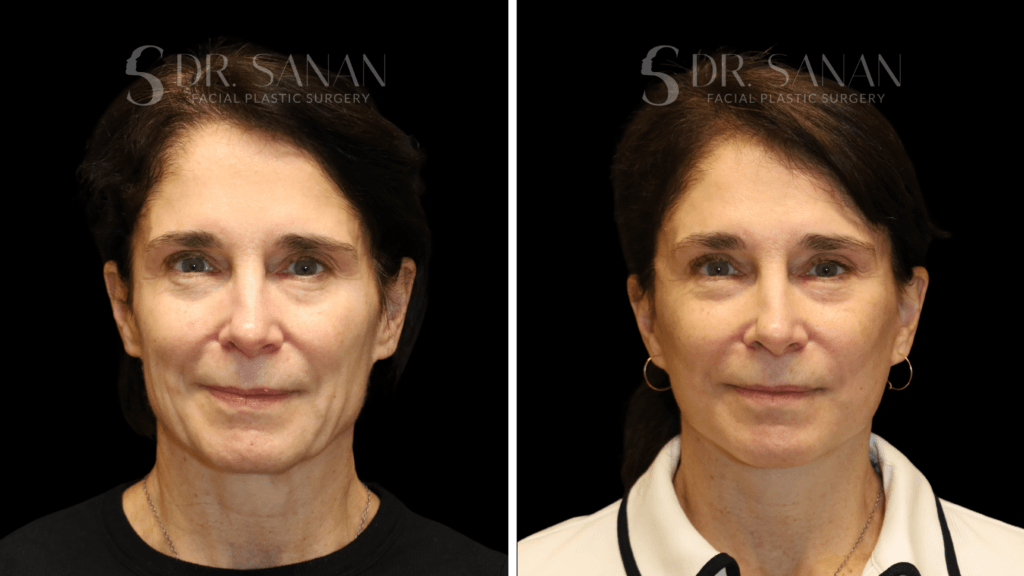 AS-LIPLIFT-01
