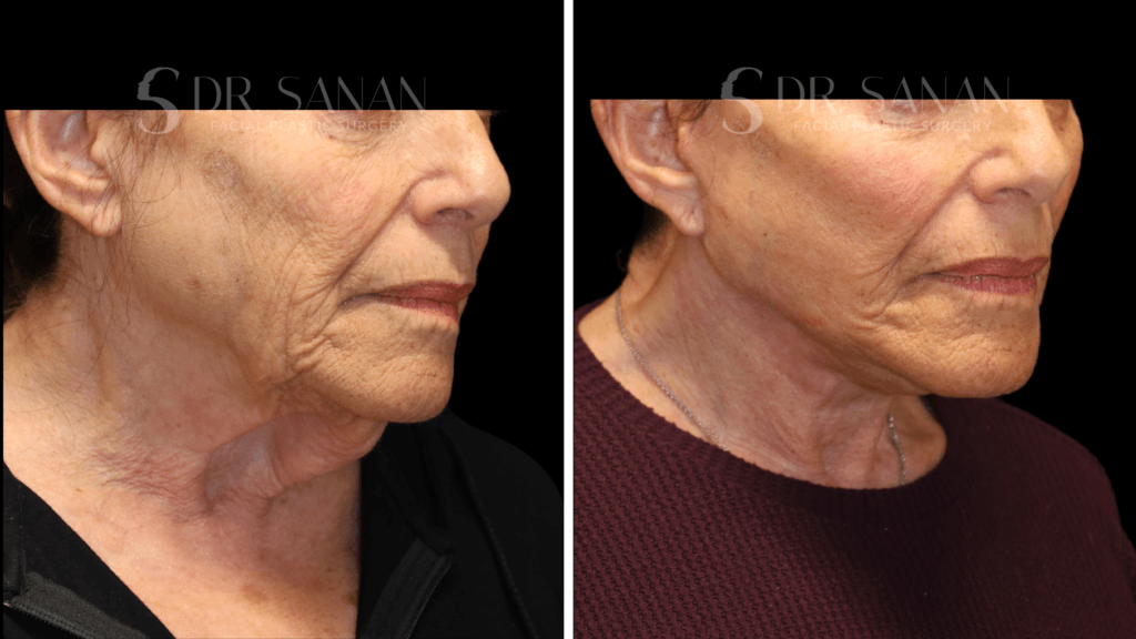 Deep plane facelift before and after in Boston, front view, 3 months