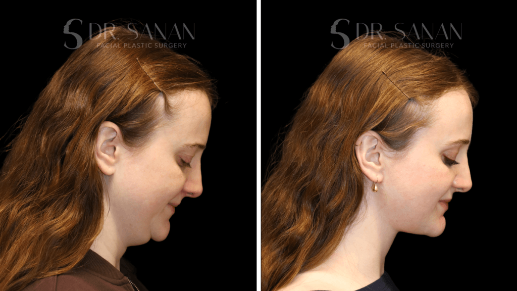 Deep plane neck lift + buccal fat pad reduction in Boston, profile view, after photo