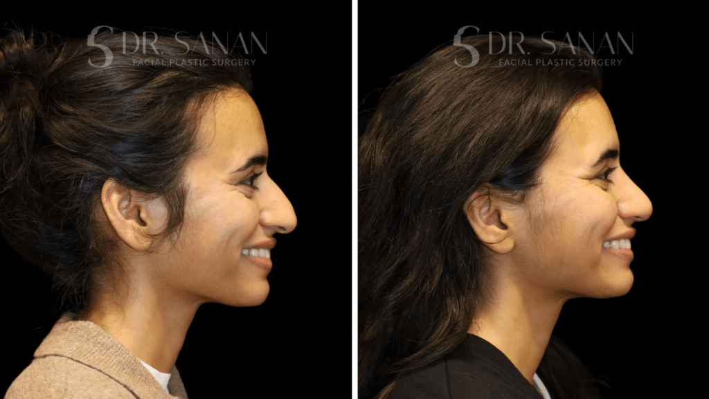 Before and after ultrasonic piezo rhinoplasty side profile photos showing refined nasal contour, a smoother bridge, and a more balanced profile while maintaining natural facial harmony.