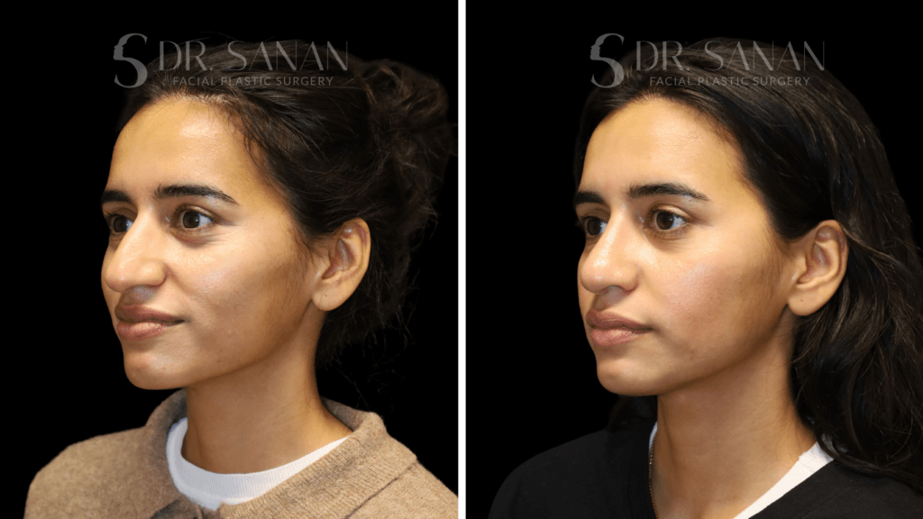 AS-LIPLIFT-01 (5)
