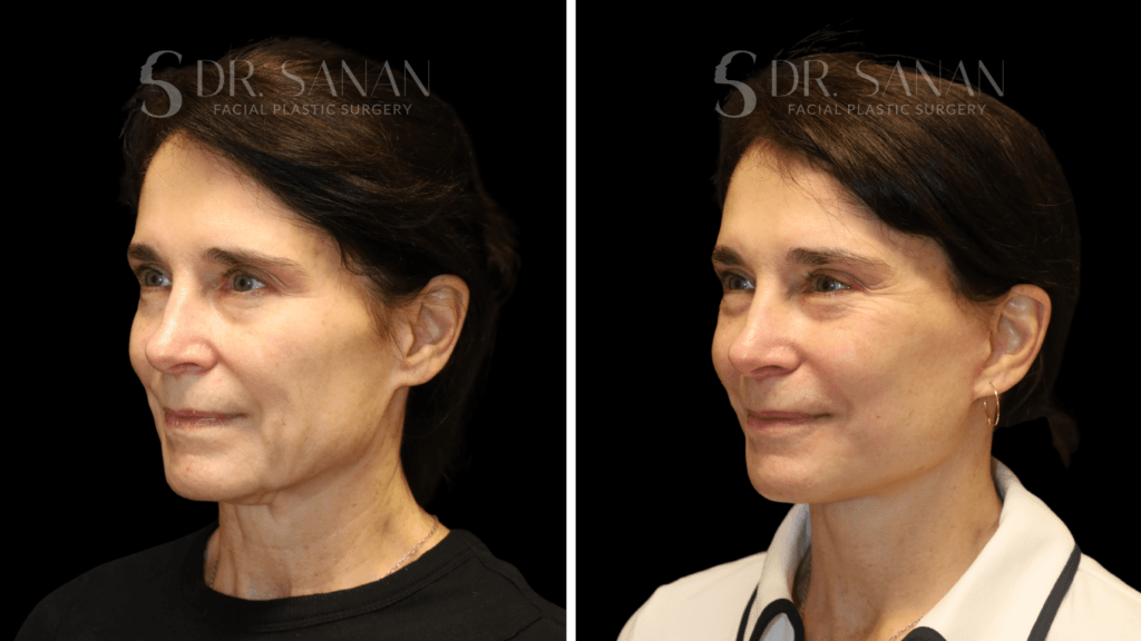 AS-LIPLIFT-01 (6)