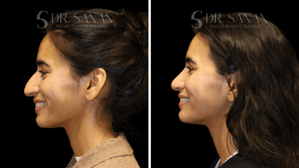 AS-LIPLIFT-01 (7)