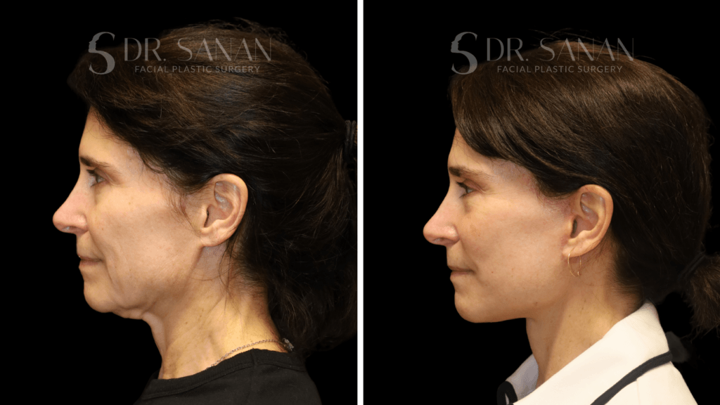 AS-LIPLIFT-01 (7)